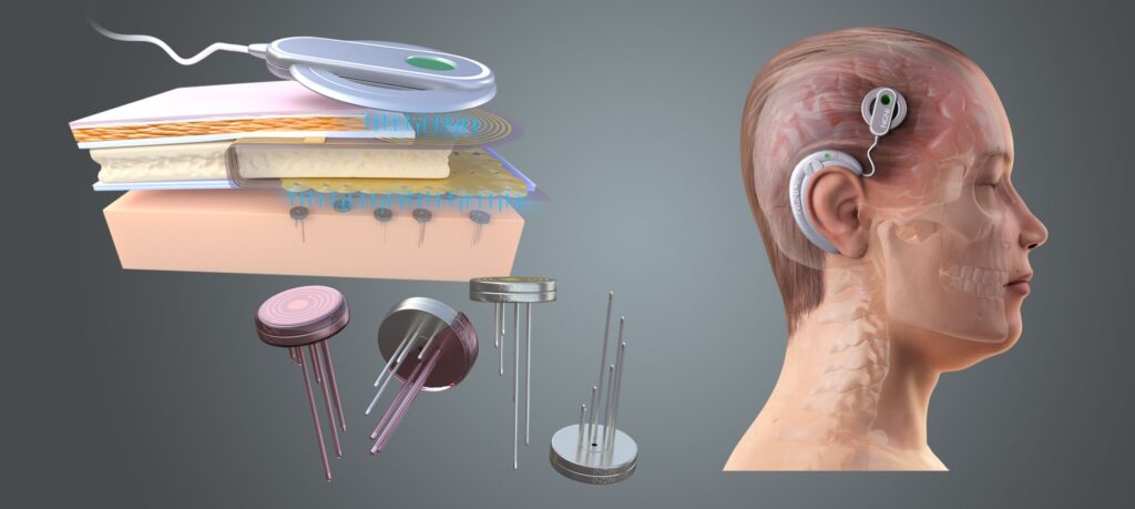 Neural Implants: Boost Your Brainpower
